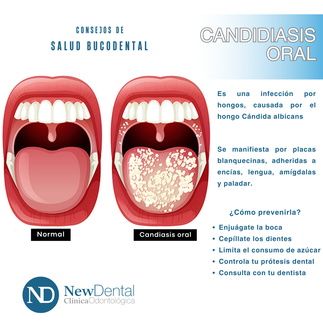 candidiasis-oral-new-dental-clinica-odontol-gica-toledo